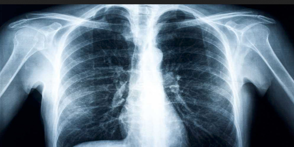 Investigador de c&aacute;ncer de pulm&oacute;n diagnosticado con la enfermedad